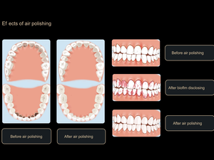 Nuovo Prodotto Dentale AP-H Lucidatore ad Aria, Modalità Sopragengivale e Sottogengivale Due in Uno, con Ugello Incluso - Product Image 5