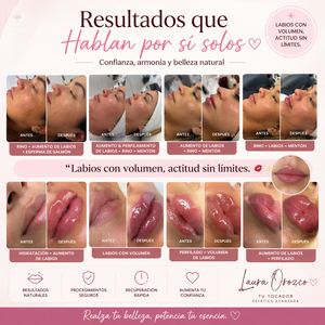 Relleno Labial con Vitamina B12 Certificado por la CE, Gel Rojo <span class=keywords><strong>de</strong></span> Ácido Hialurónico Reticulado, Relleno Dérmico Inyectable para <span class=keywords><strong>Aumento</strong></span> <span class=keywords><strong>de</strong></span> <span class=keywords><strong>Labios</strong></span> - Product Image 2