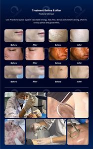 Équipement de beauté au laser fractionné CO2 FraxPre 10600nm Ultra Pulse pour le traitement de la peau du visage et du corps, utilisation en gynécologie et en dermatologie - Product Image 5