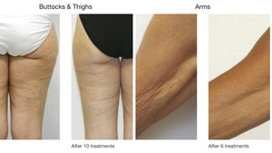 Máquina de Vacío y Calor Venus para Masajes, Adelgazamiento, Belleza y Cuidado de la Piel, Uso Personal en el Hogar - Product Image 5