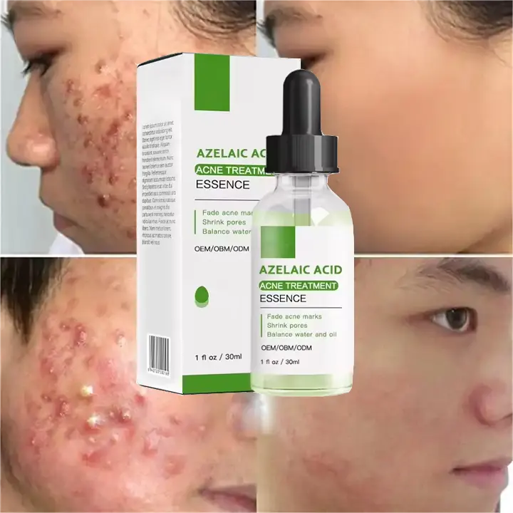 Soro anti-acne para tratamento com ácido azelaico, soro coreano OEM para remoção de rosto e cuidados com a pele
