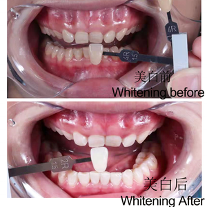 Dr. odontoiatrico Kit sbiancante professionale di migliore qualità dei denti prodotto per la clinica dentale - Product Image 3