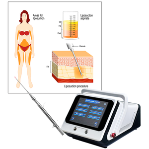 लिपोसक्शन सौंदर्य चिकित्सा सर्जरी वसा लिपोलिसिस एंडो लेजर फाइबर 1470 980nm वैज़र कैनुला वसा सक्शन मशीन - Product Image 1