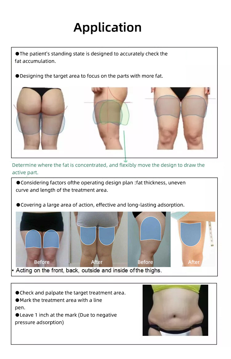 coolsculpting machine application