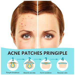 Parches Hidrocoloides para Granos, 180 Unidades, 12mm y 8mm, Circulares, Invisibles, Transpirables e Impermeables para el Acné Facial - Product Image 2
