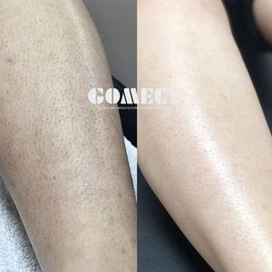 Appareil d'épilation au <span class=keywords><strong>laser</strong></span> à diode intelligent portable le plus vendu <span class=keywords><strong>2022</strong></span>, haute puissance 755 808 1064nm - Product Image 2