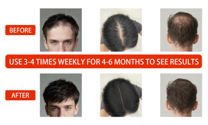 Bestseller Stehende LED-Rotlichttherapie-Haarkappe mit 650nm Wellenlänge 126 Dioden zur Behandlung von Haarausfall Multi-Stecker - Product Image 4