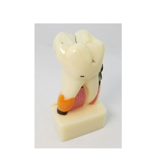 Modelo de Parodontopatía de 4 veces, modelo de demostración de educación dental - Product Image 2