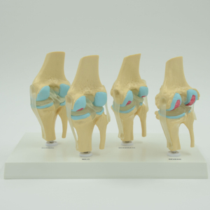Modelo de Articulación de Rodilla, 4 Etapas de Lesiones: Normales, Ligeras, Moderadas y Severas, Patología de Osteoartritis, para Enseñanza Médica - Product Image 1