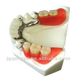 Prothèses dentaires amovibles avec cadre métallique imprimé <span class=keywords><strong>en</strong></span> 3D par laser, fabriquées <span class=keywords><strong>en</strong></span> Chine, laboratoire dentaire, <span class=keywords><strong>prix</strong></span> d'usine - Product Image 5