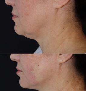 Endo Face Lift Dispositivo de láser óptico de Cirugía Dental portátil 980nm + 1470nm Diodo Láser Liposucción Reutilizable Fibra óptica médica - Product Image 5