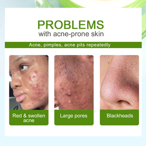 Kit de Creme Diurno OEM&ODM para Remoção de Acne e Manchas Escuras com Colágeno e Glicerina para Pele Sensível - Product Image 2