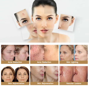 Machine portable IPL Machine Rajeunissement de la peau IPL E Light Nouvel équipement de <span class=keywords><strong>photorajeunissement</strong></span> - Product Image 5