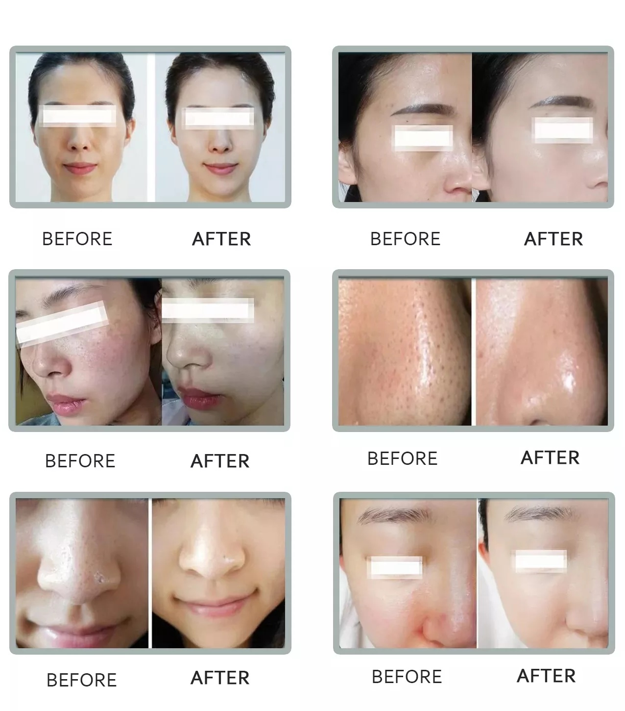 Portable m6 Aqua Facial Jet Peel Micro Dermabrasion Pore Vacuum Blackhead Remover Hydra skin peel  hydro spa Facial Machine