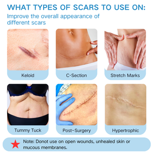 แผ่นซิลิโคนเกรดทางการแพทย์สำหรับรักษารอย<span class=keywords><strong>แผล</strong></span>เป็น ขายส่งจากโรงงาน แผ่นปิดรอย<span class=keywords><strong>แผล</strong></span>เป็นแบบใช้ซ้ำได้ สำหรับรอยแผลผ่าตัด รอยแผลเป็นชนิดคีลอยด์ และรอย<span class=keywords><strong>แผล</strong></span>ผ่าคลอด - Product Image 6