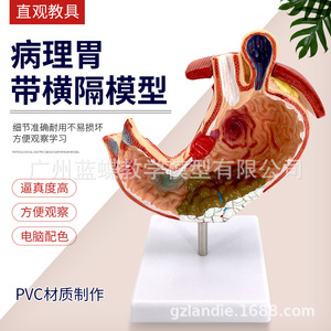 Modelo anatómico gástrico, modelo de estómago con enfermedades, modelo de demostración de enfermedades gástricas, modelo de estómago patológico, humano - Product Image 2