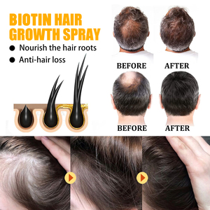 Suero de Crecimiento Capilar Orgánico con Biotina, Aceite Esencial 30ml, Tratamiento Profesional para la Pérdida Rápida del Cabello, Alivio de la Calvicie, <span class=keywords><strong>Hidratante</strong></span> y Suavizante - Product Image 6