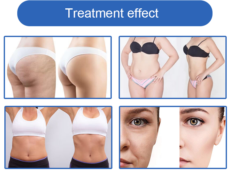 Astiland Cryolipolysis Fat Freezing Machine Spa Supplies Beauty Equipment