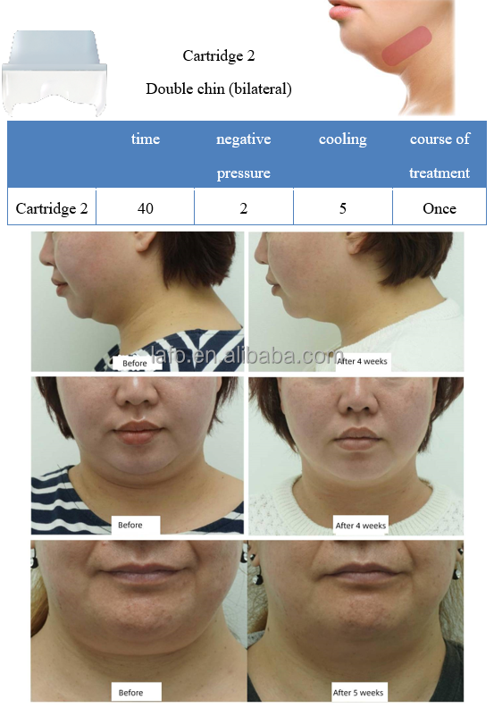 2022 360 cryolipolysis new technology professional body contouring fat reduce weight loss machine for sale LF-268