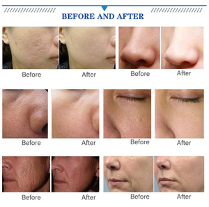 Digital Anti-Aging Desktop Meso Therapy <b>Gun</b> 5/9 Pins Electroporation No-Needle Device Face Multi-Voltage US/AU Pore Shrinking - Product Image 6