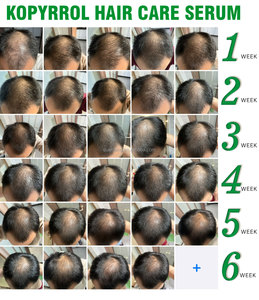 Sérums pour la repousse des cheveux à base de DHT, marque privée, traitement naturel contre la perte de cheveux, soin du cuir chevelu, biotine, sérum pour la croissance rapide des cheveux - Product Image 2