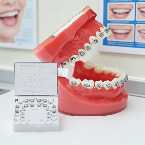 Brackets de Ortodoncia Autoligables Shinye Mini Roth <span class=keywords><strong>Damon</strong></span> para Ortodonistas Especialistas - Product Image 1