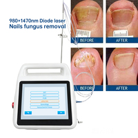 Endotight 980 et 1470 nm 50W Traitement efficace de l'onychomycose (mycose des ongles) Autres produits de beauté et de soins personnels