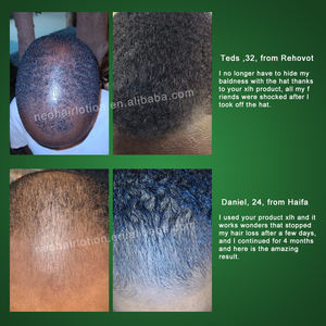 Cabelo selvagem Crescimento Orgânico Óleo Balde <span class=keywords><strong>Anti</strong></span> Perda De Cabelo Tratamento para a Calvície Neo Loção Cabelo 120ml - Product Image 3