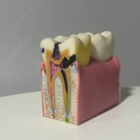 Modelo DE EDUCACIÓN anatómica para caries dental 6 demostraciones de sección transversal bilateral para estudio de ciencia médica