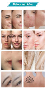 เครื่องเลเซอร์ IPL 3 in 1 กำลังไฟ 1000 วัตต์ ราคาสุดคุ้ม สำหรับกำจัดขนถาวร ยกกระชับใบหน้า และตัดกระจก-ใช้ได้ทั้งในเชิงพาณิชย์และที่บ้าน - Product Image 4