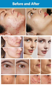 Lente de Enfoque para Láser de CO2 de 120w al Mejor Precio 2026, para Acné, Arrugas, Poros, Manchas, Estrías/Cicatrices, Láser de CO2 Fraccionado para SPA y Salón de Belleza - Product Image 6