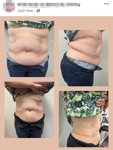 Appareil de Cavitation Lipo <span class=keywords><strong>Professionnel</strong></span> 30K avec 14 Grandes Plaques pour Élimination des Graisses, Amincissement Corporel et <span class=keywords><strong>Anti</strong></span>-<span class=keywords><strong>Cellulite</strong></span> (Effet Fraise) - Product Image 4