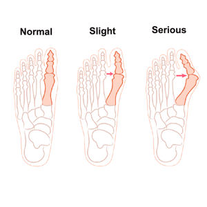 Pemisah jari kaki Bunion Orthotics koreksi Hallux Valgus perawatan kaki ortopedi pemisah jari besar pereda nyeri kaki perawatan HA00524 - Product Image 5