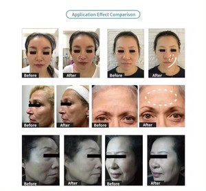 New Electroporation không có kim Mesotherapy Máy vẻ đẹp thiết bị - Product Image 4