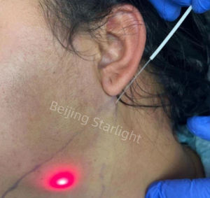 Endoláser para Ojos y Lifting Facial, Diodo <span class=keywords><strong>de</strong></span> 1470nm, Láser <span class=keywords><strong>de</strong></span> Rejuvenecimiento Facial, Láser <span class=keywords><strong>de</strong></span> Lipólisis, Pérdida <span class=keywords><strong>de</strong></span> Grasa, Máquina <span class=keywords><strong>de</strong></span> Endoláser <span class=keywords><strong>de</strong></span> 1470 - Product Image 3