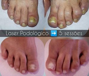 Láser <span class=keywords><strong>de</strong></span> podiación 4 en 1 para tratamiento <span class=keywords><strong>de</strong></span> uñas, dispositivo <span class=keywords><strong>de</strong></span> alta potencia 4 en 1 para podiación <span class=keywords><strong>de</strong></span> uñas, 60w, onicomicosis nd yag 1064nm, 980nm, TR980-V1 - Product Image 5