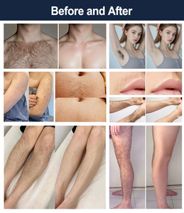 เครื่องเลเซอร์กำลังสูง 2000 วัตต์ เครื่องกำจัดขนด้วยเลเซอร์แบบมืออาชีพ ไดโอด 4 ความยาวคลื่น 808 ไดโอดเลเซอร์กำจัดขน - Product Image 6