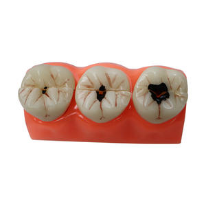 Modelo Anatómico de Caries Dental de Resina, Modelo de Dientes para el Cuidado Bucal, para Educación en Ciencias Médicas - Product Image 3