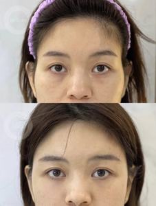 Ollyvia  Remplisseurs pour les tempes, les plis nasogéniens et les <span class=keywords><strong>joues</strong></span> affaissées - Product Image 3