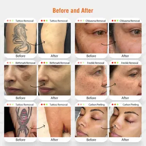 Eliminación de tatuajes con láser Pico 532 1064 1320nm para blanqueamiento de la piel estilo estacionario con láser de picosegundos con enchufe UK/au