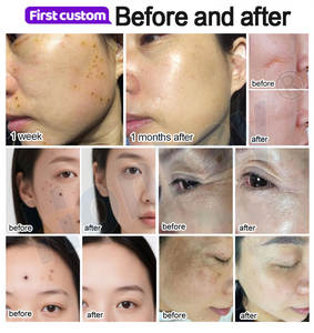 Dispositivo de Plasma Portátil para Tensar Párpados, Eliminar Cicatrices de Acné, Eliminar Lunares, Reducir Arrugas - Product Image 6