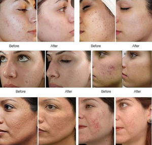 เครื่องปรับรูปร่าง Morph 8 รุ่นปี 2026 ยกกระชับใบหน้า กำจัดเซลลูไลท์ กระชับสัดส่วน ต่อต้านริ้วรอย บำรุงผิว ลดเลือนริ้วรอย - Product Image 6