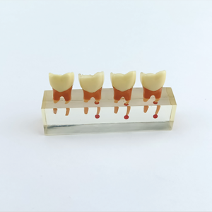 Modello Didattico Dentale Trasparente per Pratica Radicolare, Modello di Denti con Malattie per Studio e Trattamento Endodontico - Product Image 3