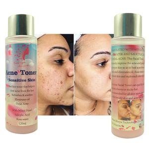 Meilleur Tonique Visage : Traite Efficacement <span class=keywords><strong>l</strong></span>'Acné et <span class=keywords><strong>les</strong></span> <span class=keywords><strong>Boutons</strong></span>, Hydrate, Éclaircit, Répare et Apaise la Peau - Tonique Anti-Acné - Product Image 3