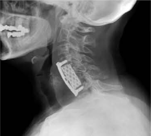 Orthopedische <span class=keywords><strong>Implant</strong></span> Titanium Mesh Met Anterior Platen Cilindrische Interbody Fusion Kooi Prismatische Gat - Product Image 2