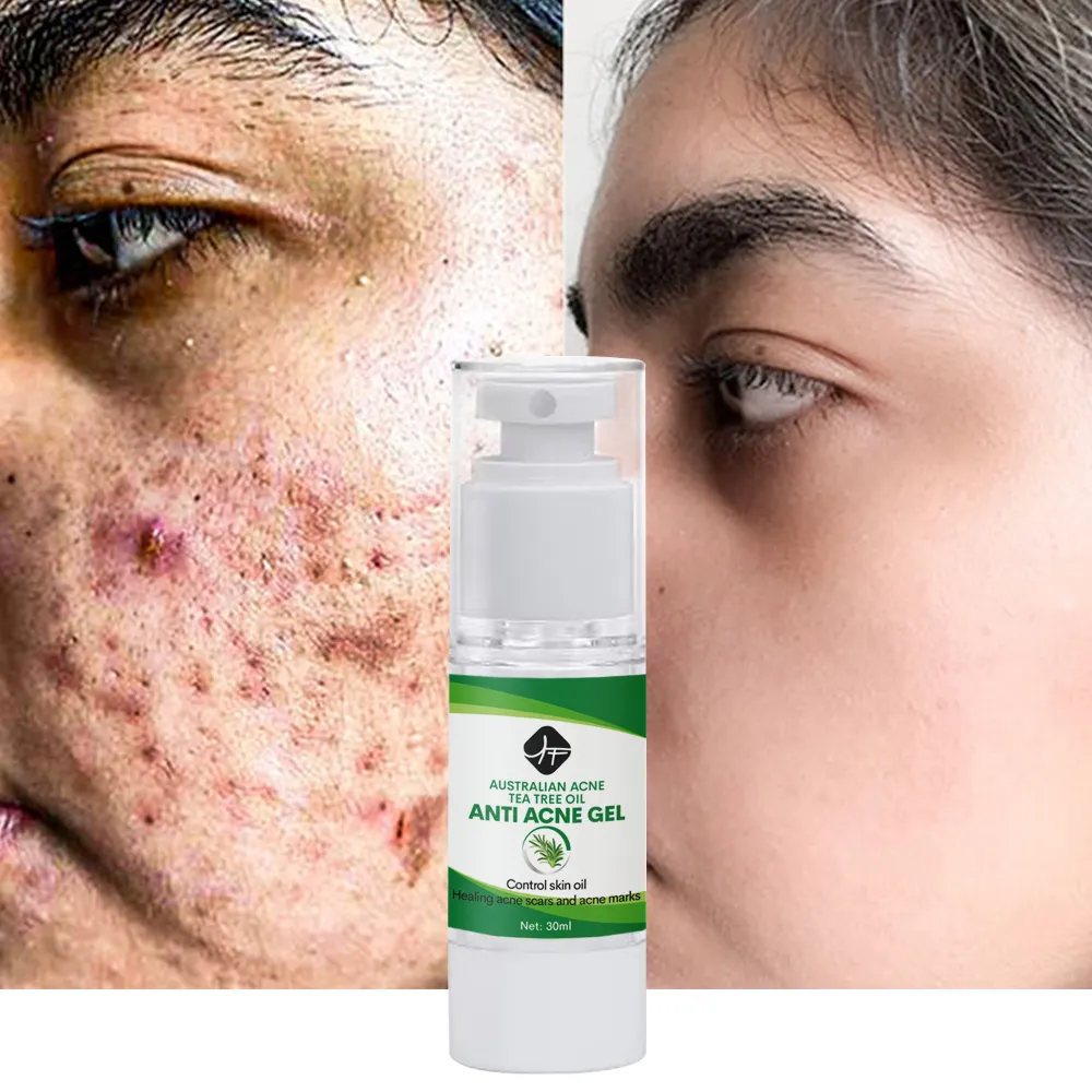 OEM/ODM Etiqueta Privada cuidado facial tratamiento antiacné marcas gel de árbol de té orgánico crema de eliminación de cicatrices de acné