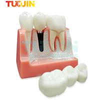 Modèle d'implant dentaire, couronne, pont, modèle amovible, modèle de dents en porcelaine, modèle de démonstration dentaire pour l'enseignement des dentistes