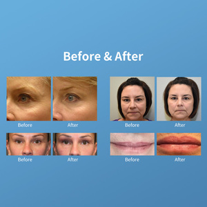 เครื่องไฮดรามาสเตอร์ 2022 สำหรับทำทรีทเมนต์ผิวหน้า เครื่องมือเสริมความงามระดับมืออาชีพ 15 in 1 พร้อมเครื่องวิเคราะห์สภาพผิวและไฮโดรเดอร์มาเบรชั่น - Product Image 6