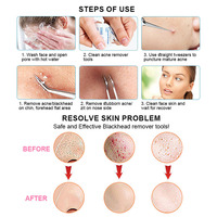 Kit de pincettes pour dissolvant de points noirs incurvé pour le visage