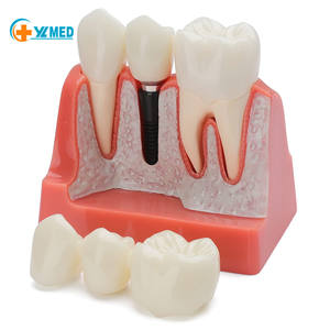 Modèle d'implant dentaire pour l'éducation des patients, modèle d'implant dentaire, <span class=keywords><strong>de</strong></span> couronne et <span class=keywords><strong>de</strong></span> pont <span class=keywords><strong>4</strong></span> fois plus grand pour la présentation - Rose - Product Image 6